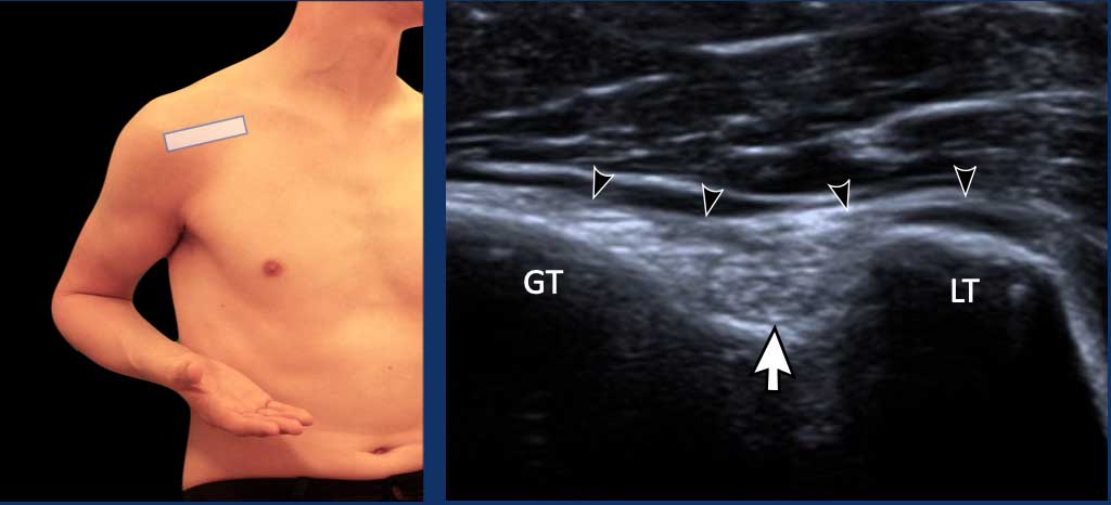 Jugger's position for rotator cuff interval examination.