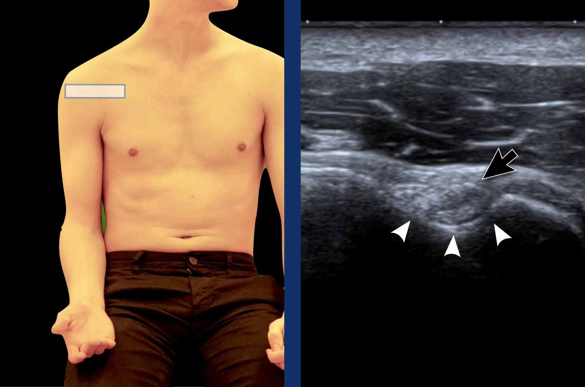 LHB examination position. Transverse view of the LHB (red arrowhead) within the intertubercular groove (green line)