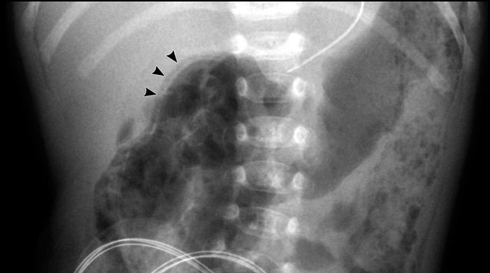 Necrotizing Enterocolitis 