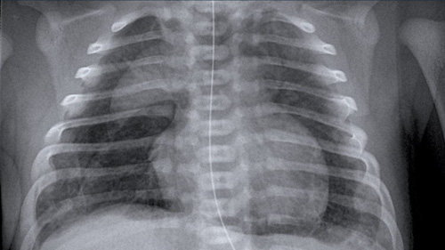 Neonatal Chest X-Ray