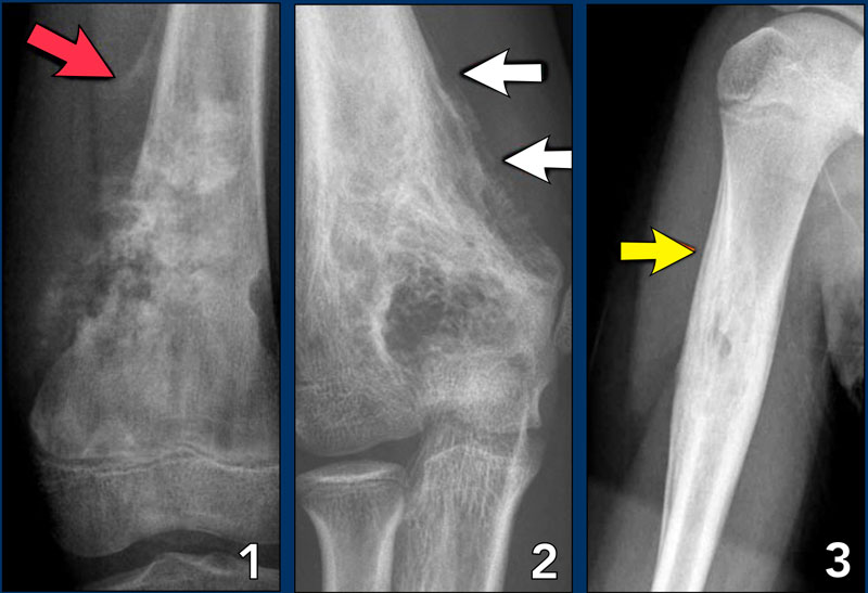 The Radiology Assistant Bone tumors Differential diagnosis