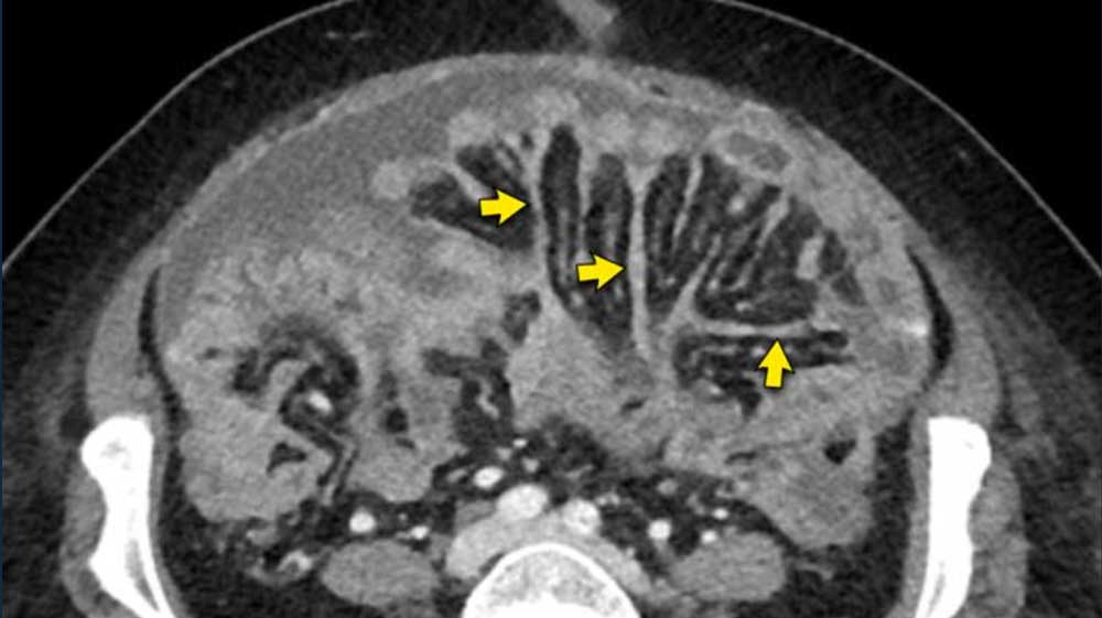 Peritoneal Carcinomatosis