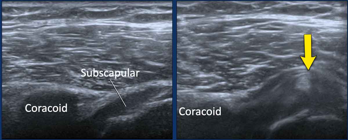 Image during exoratation (left) and endorotation (right)