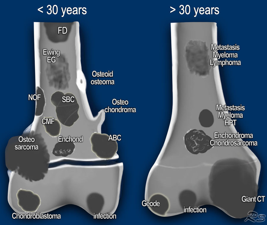 The Radiology Assistant : Bone Tumors - Differential Diagnosis