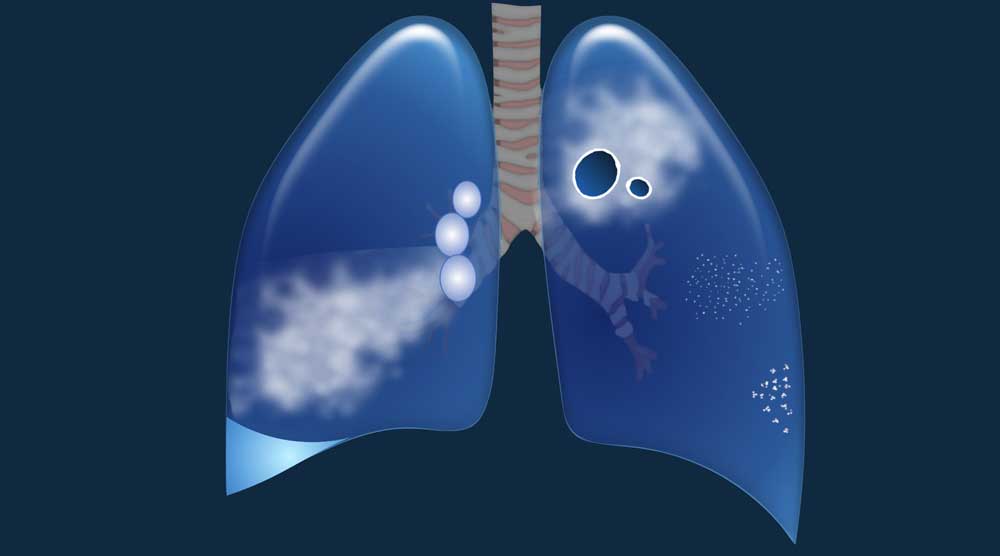 Imaging findings in TB