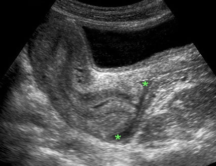 abnormal transvaginal ultrasound