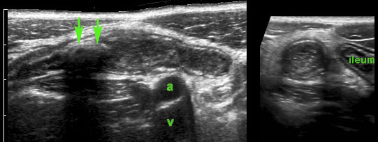 Appendicitis with intraluminal fecolith (arrows) is found at the level of obstruction (a and v = iliac artery and vein).