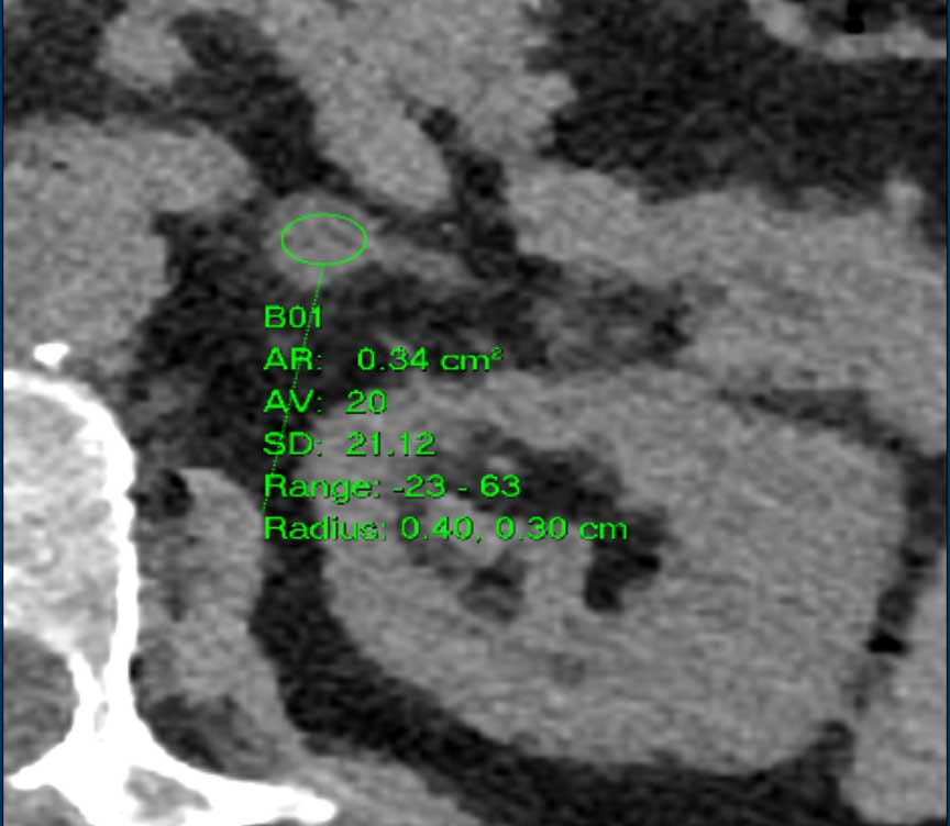 Adrenal Incidentaloma. Calculated 10th percentile for negative pixels: –7 HU.