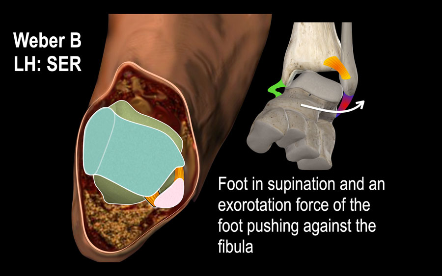 The Radiology Assistant : Ankle fractures - Weber and Lauge-Hansen  Classification