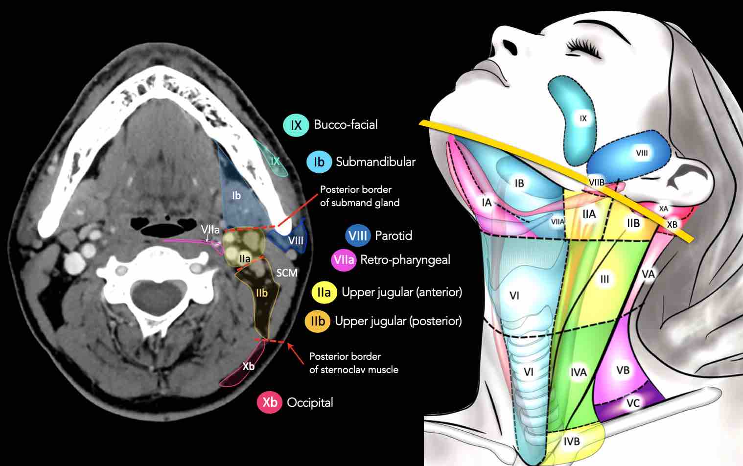 The Radiology Assistant : Cervical Lymph Node Map (2023)