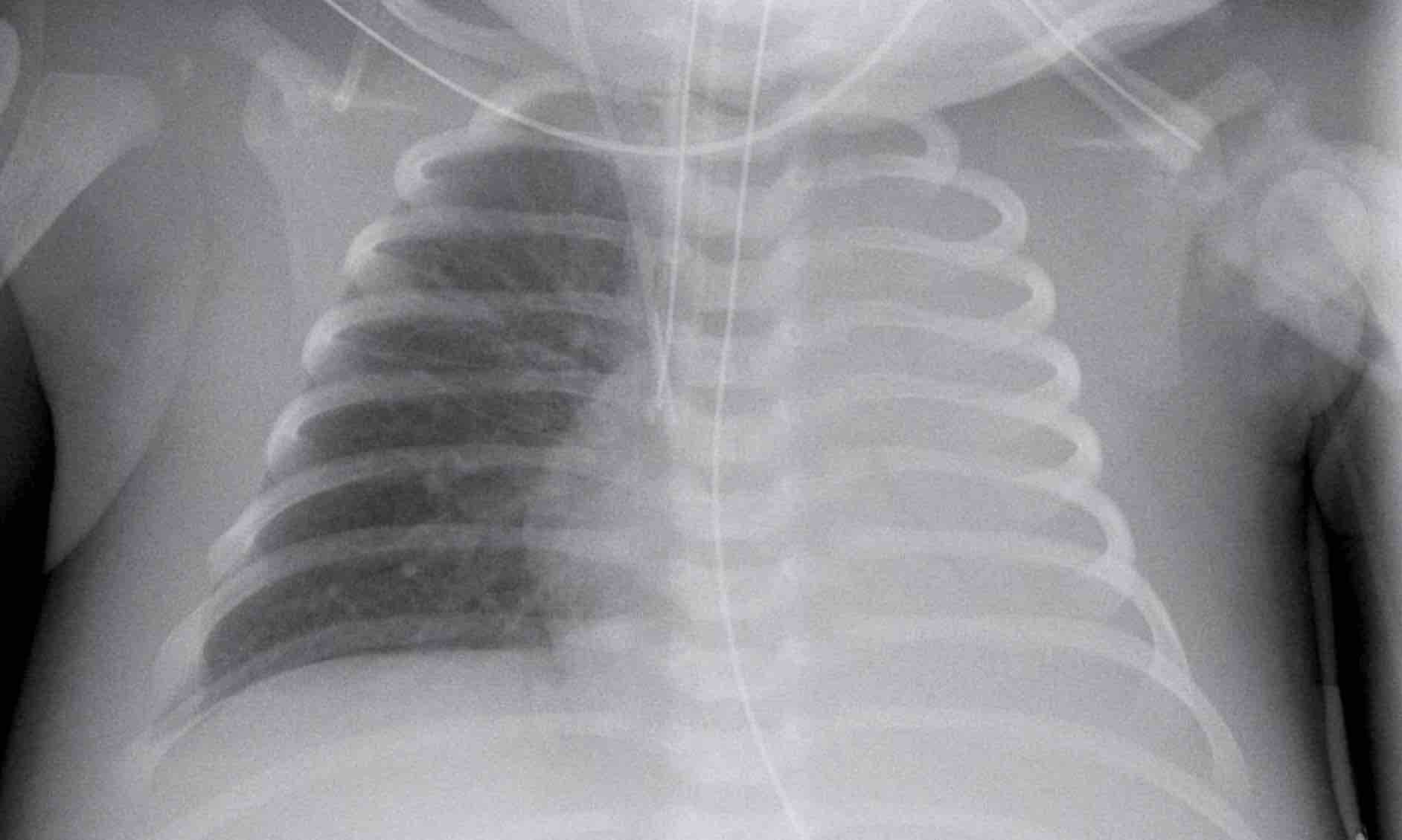 The Radiology Assistant : Neonatal Chest X-Ray