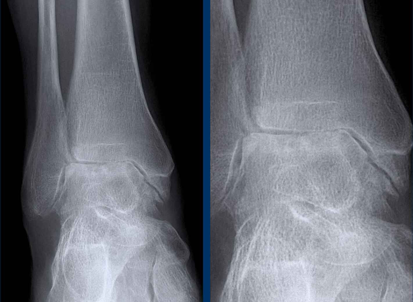 Hemophilic arthropathy of the ankle