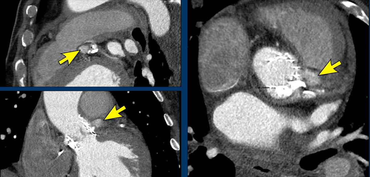 Contained rupture at left coronary cusp.