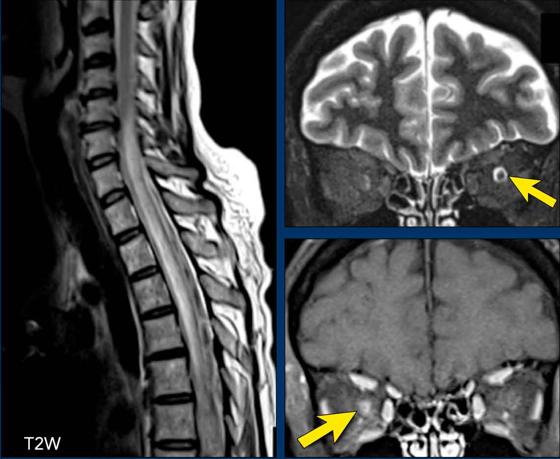 Patient with NMOSD showing a longitudinally extensive cord lesion with marked swelling. Bilateral neuritis optica. The diagnosis was confirmed by an AQP4-AB titer of 1:1024.