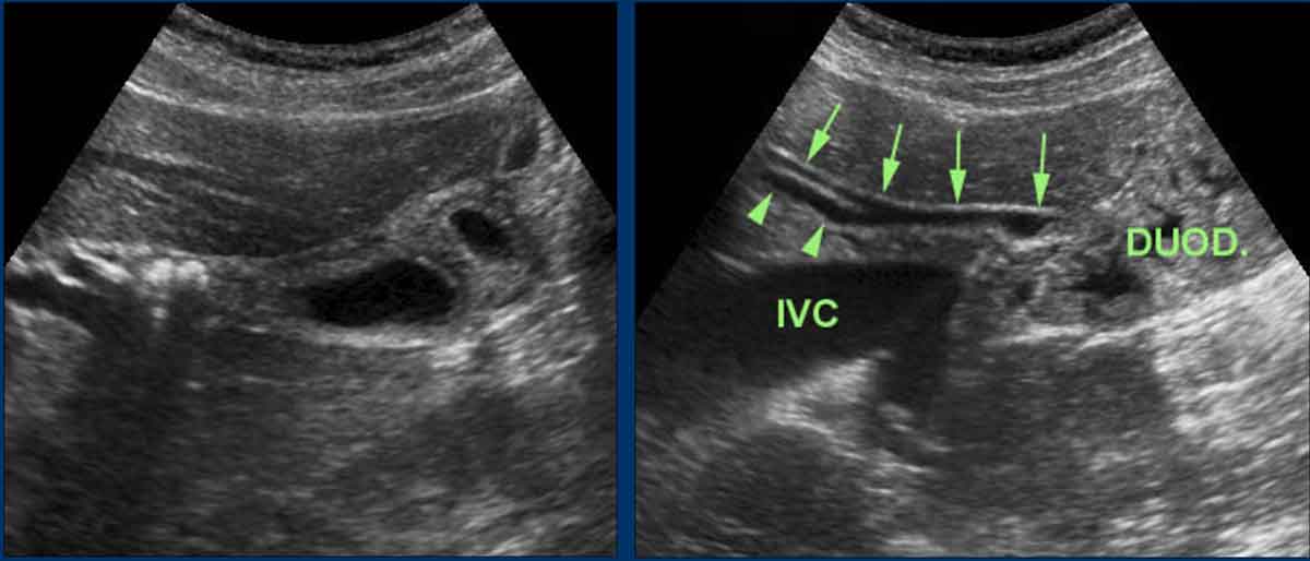 The Radiology Assistant Common Bile Duct Stones Ultrasound