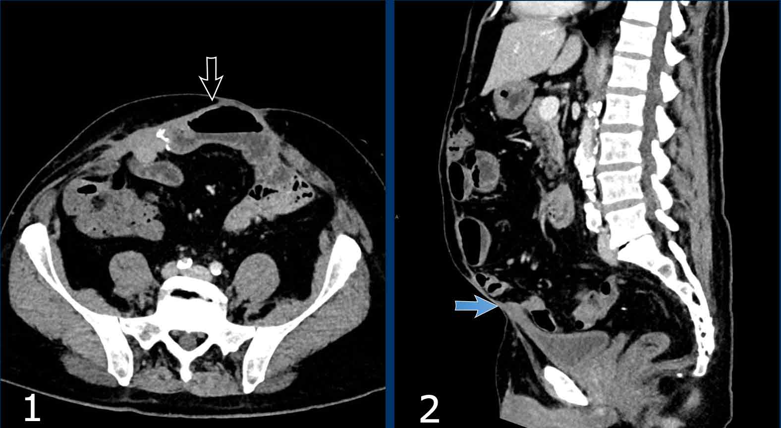 The Radiology Assistant : Abdominal Wall Hernias