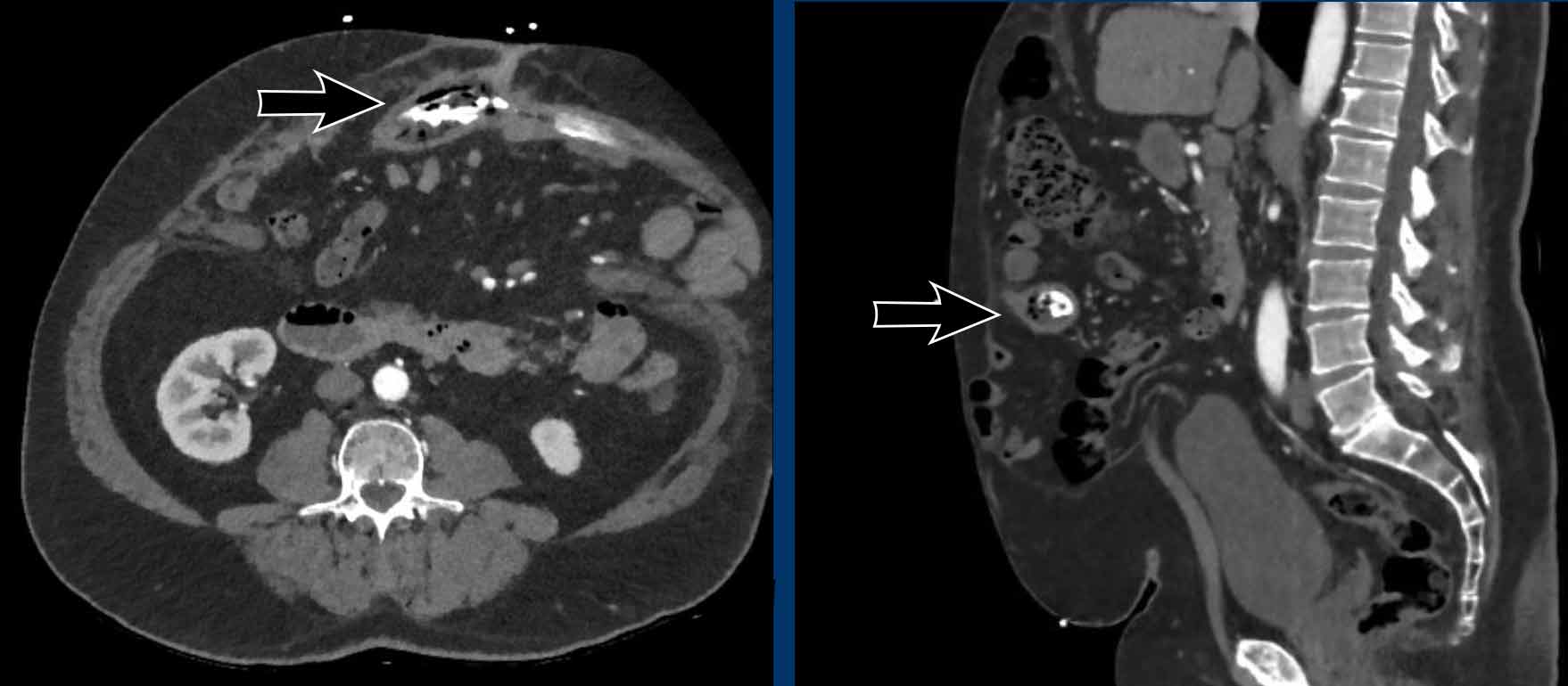 The Radiology Assistant Abdominal wall hernias