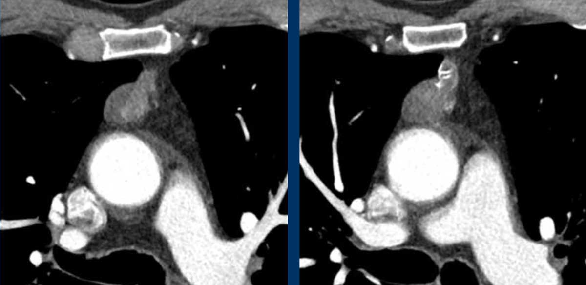 The Radiology Assistant : Thymic masses and mimics