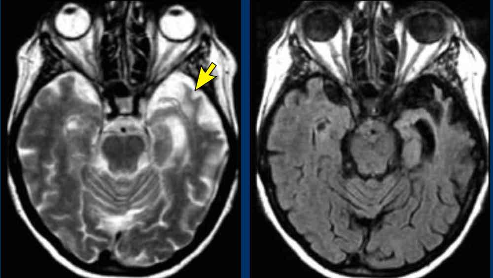 FTLD: T2WI and FLAIR with 'knife blade' atrophy of left temporal lobe with normal right temporal lobe