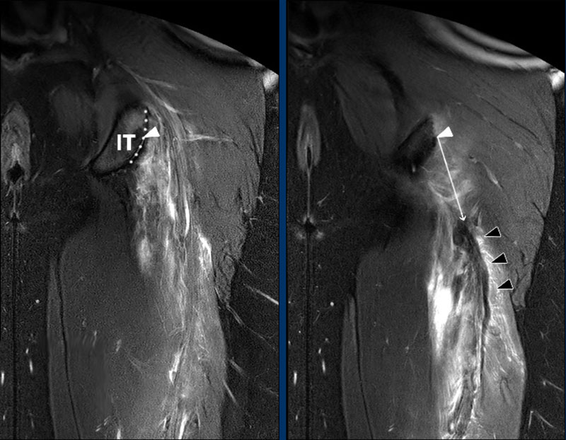 The Radiology Assistant Hamstring injury