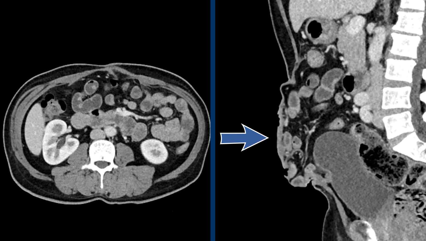 The Radiology Assistant : Abdominal Wall Hernias