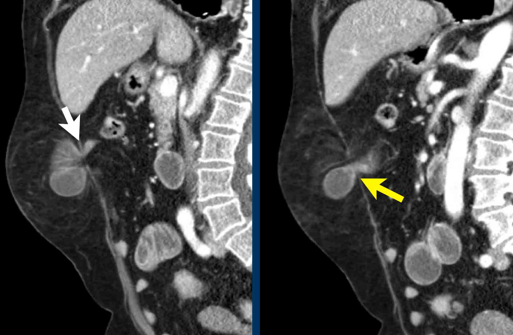 The Radiology Assistant : Abdominal Wall Hernias