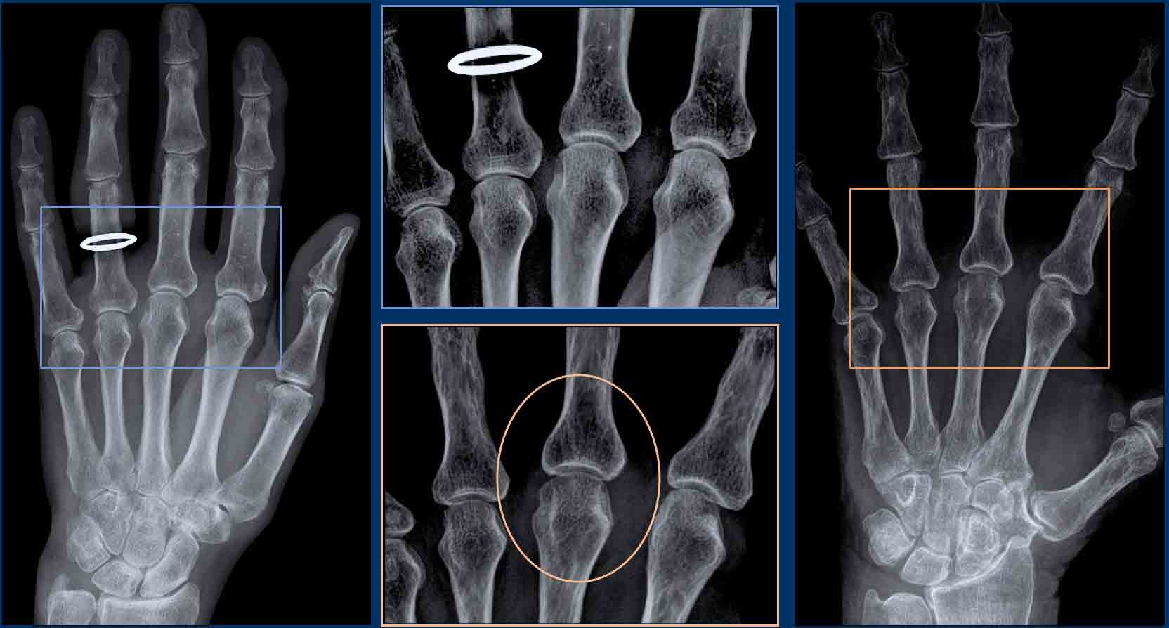 The Radiology Assistant : Arthritis