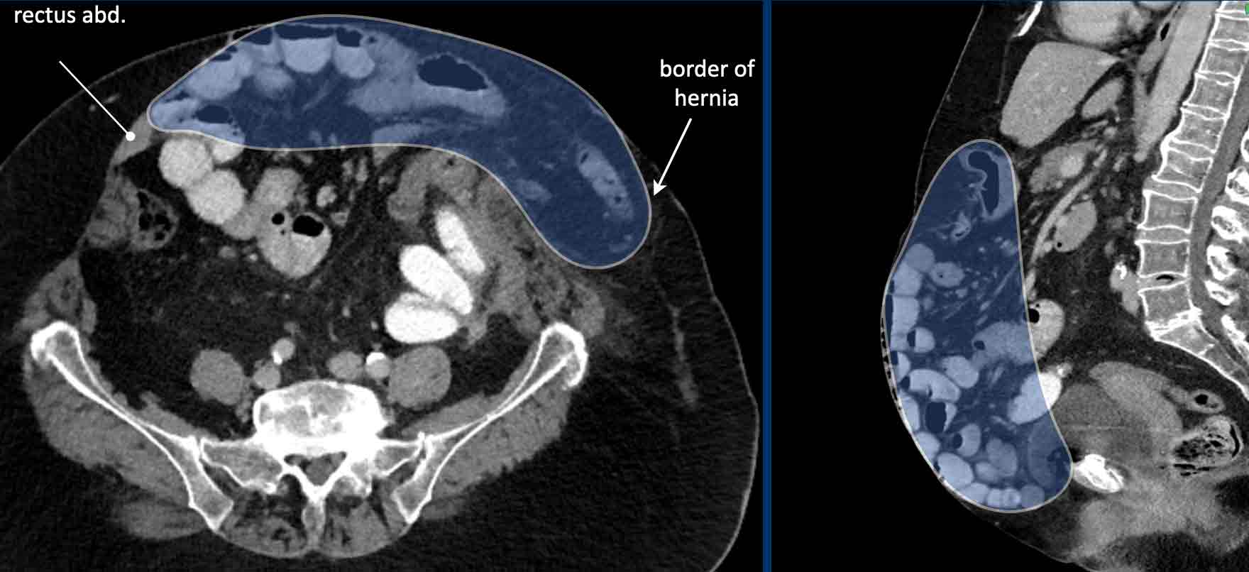 The Radiology Assistant Abdominal wall hernias