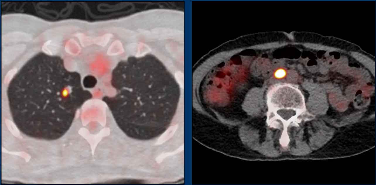 Distant metastases in a patient with anal cancer