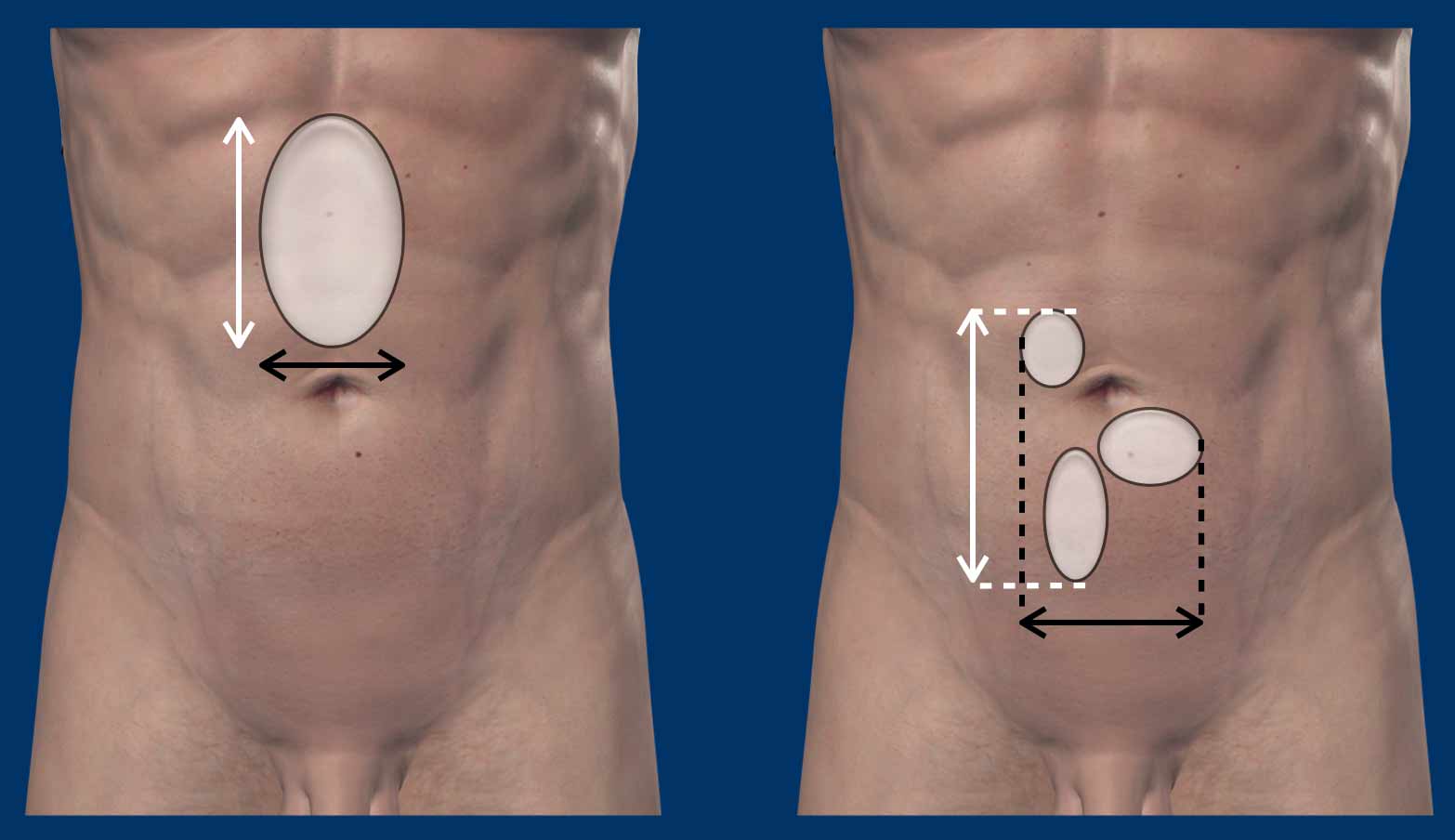 The Radiology Assistant : Abdominal wall hernias