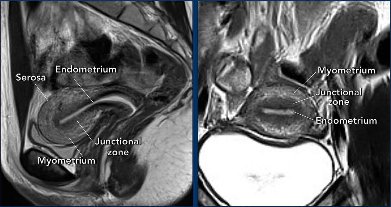 Uterus Anatomy Mri EPOS Uterus Anatomy Mri EPOS