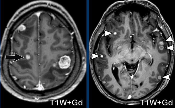 Metastases in the watershed area (black arrow) and at the gray/white matter interface (white arrowheads)