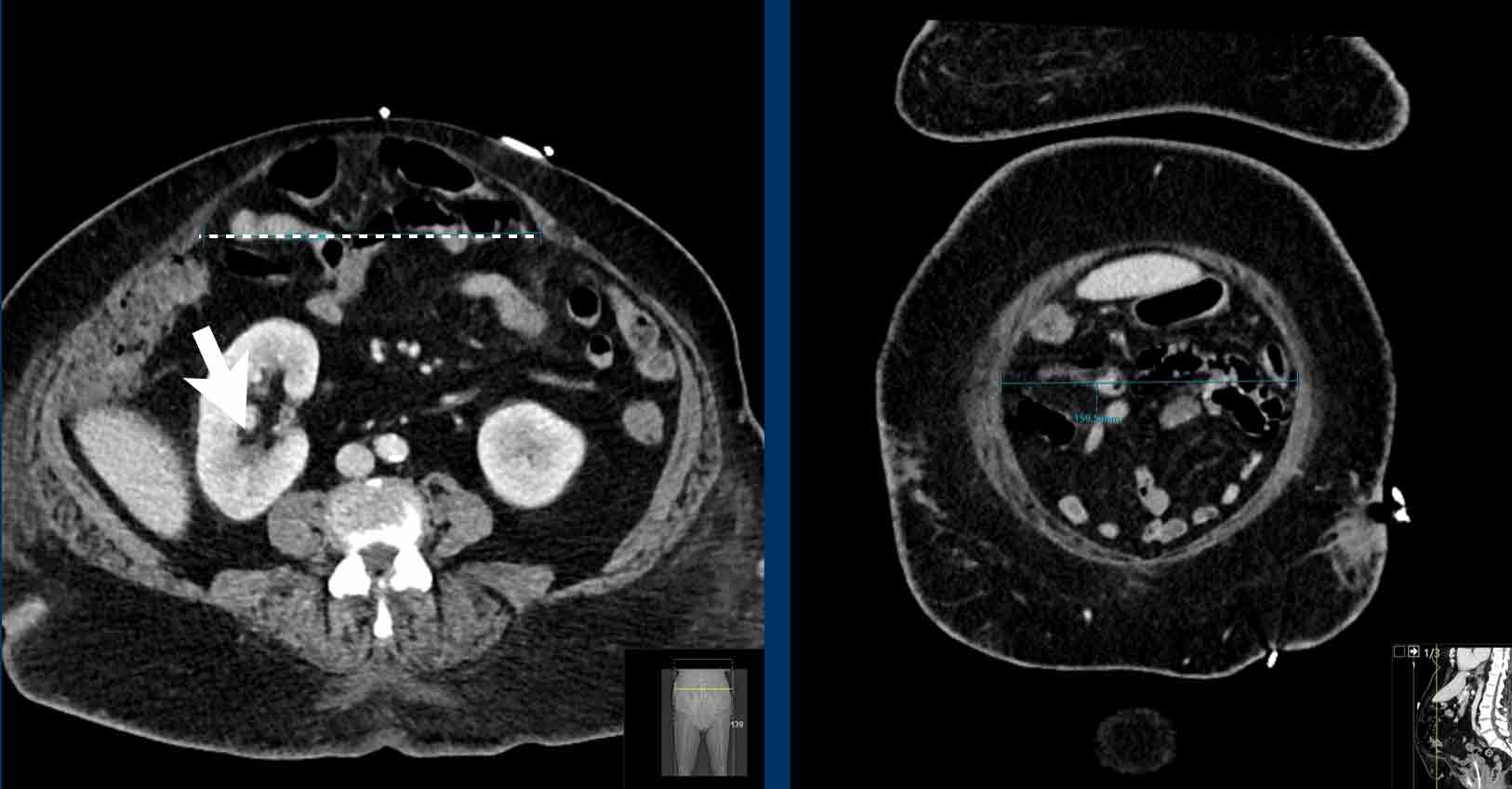 The Radiology Assistant Abdominal Wall Hernias