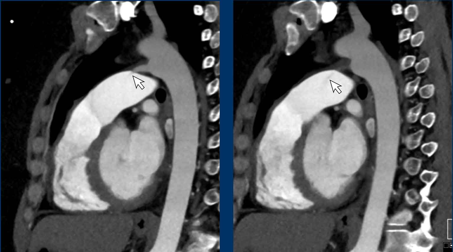 The Radiology Assistant : Cardiovascular Pearls on Chest CT.