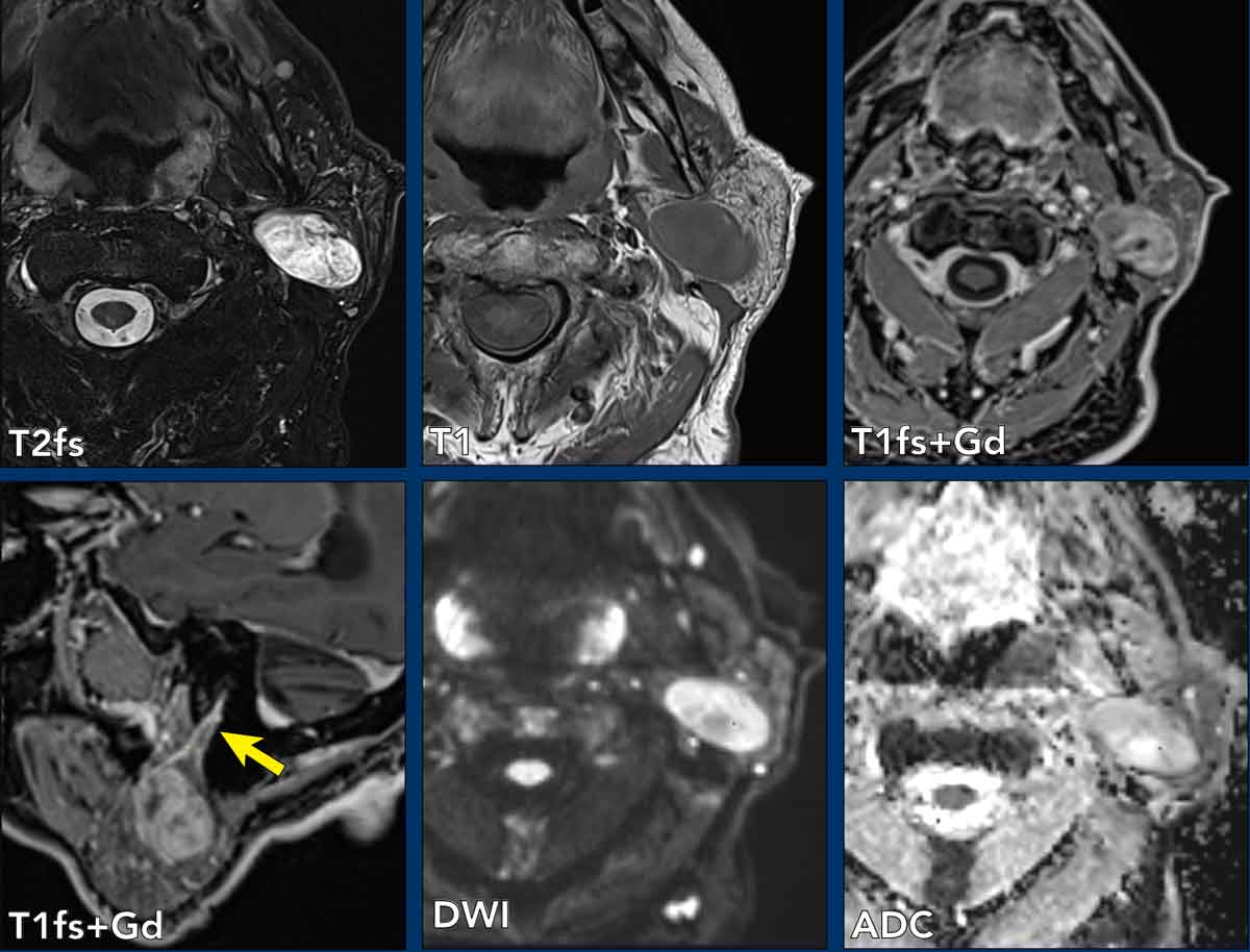 Carcinoma ex pleomorphic adenoma