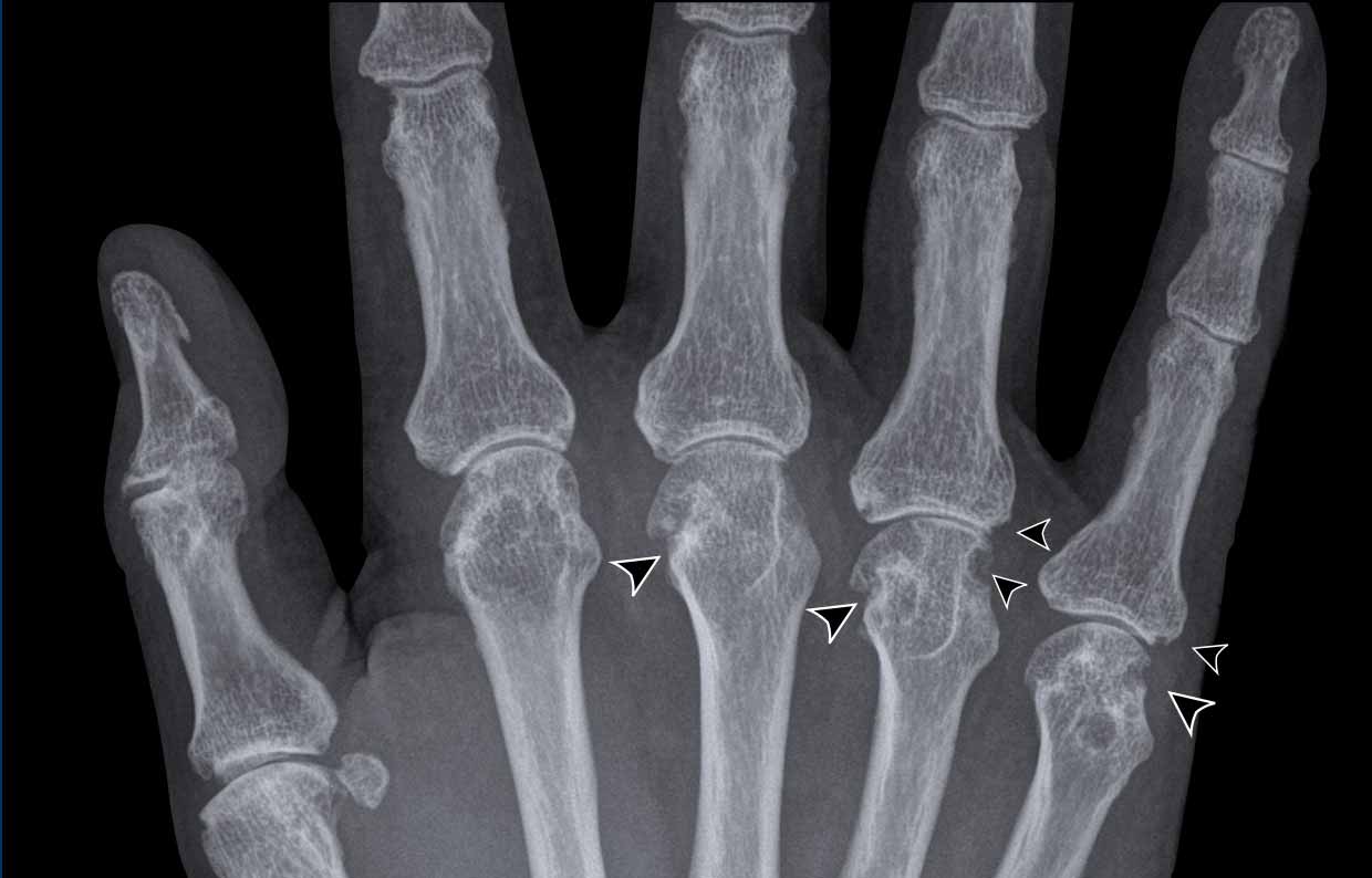 The Radiology Assistant Arthritis