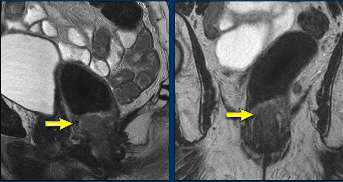 Tumor (arrow) before treatment with a suspicious mesorectal node. Stage: cT2N1a.