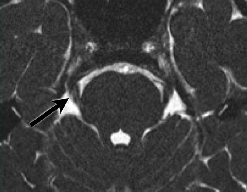 Root Entry Zone Radiopaedia _ Trigeminal Neuralgia Symptoms – LSBGB