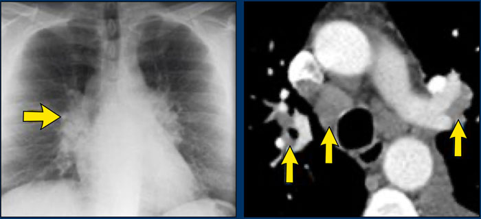 Sarcoidosis stage I: left and right hilar and paratracheal adenopathy (1-2-3 sign)