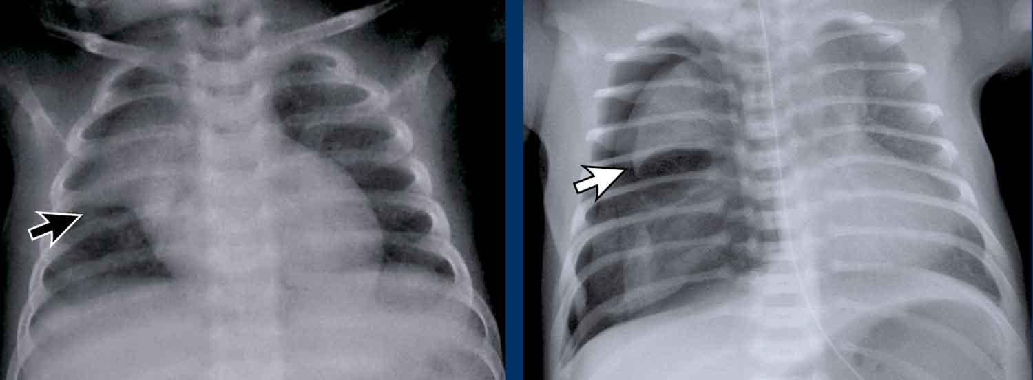 The Radiology Assistant : Thymic masses and mimics