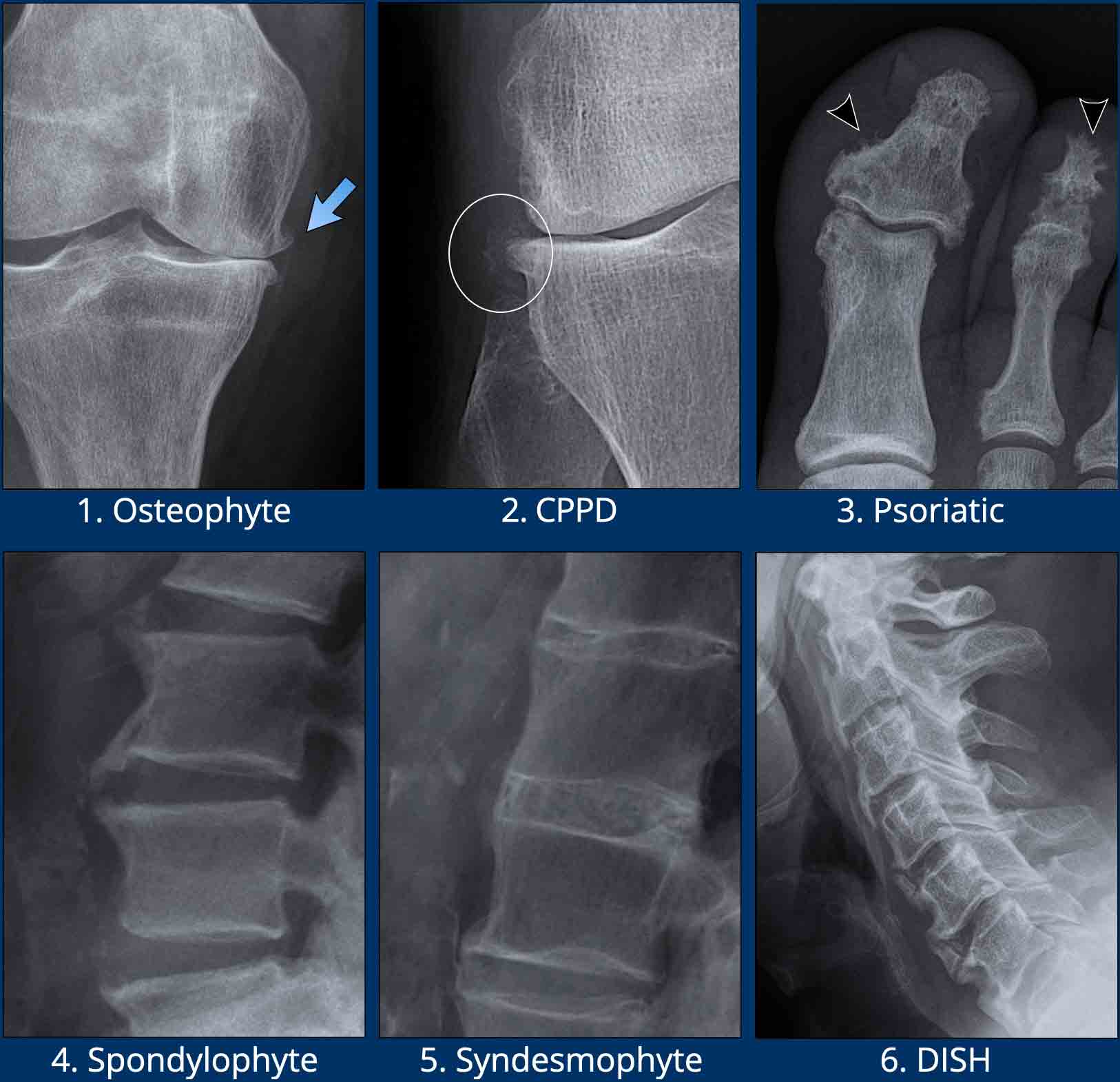 osteophytes x ray