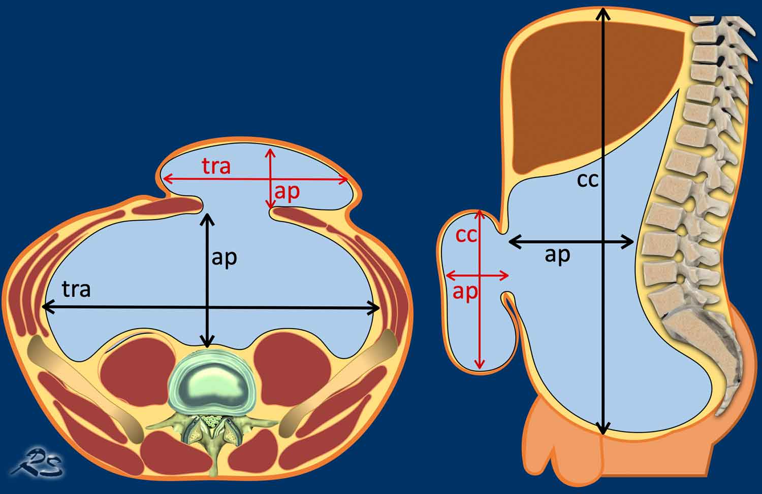 The Radiology Assistant : Abdominal Wall Hernias