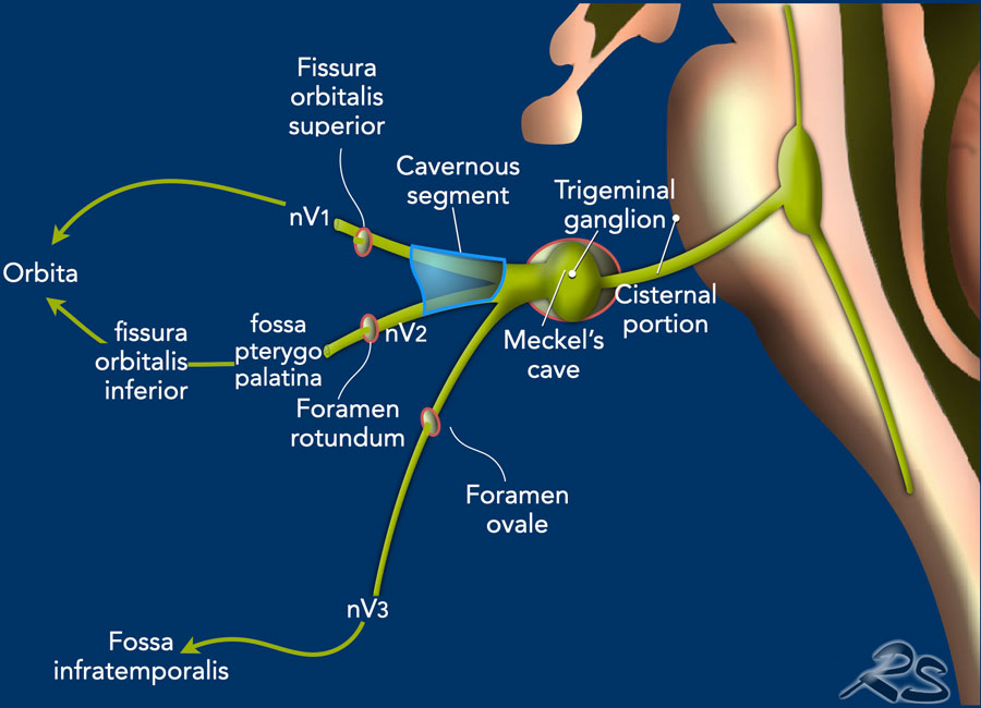 The Radiology Assistant : Trigeminal Neuralgia