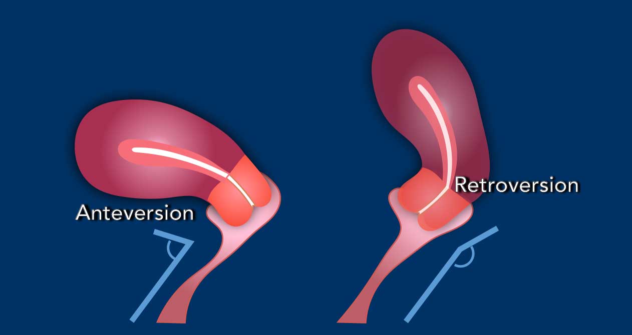 The Radiology Assistant : Cervical Cancer - MR staging