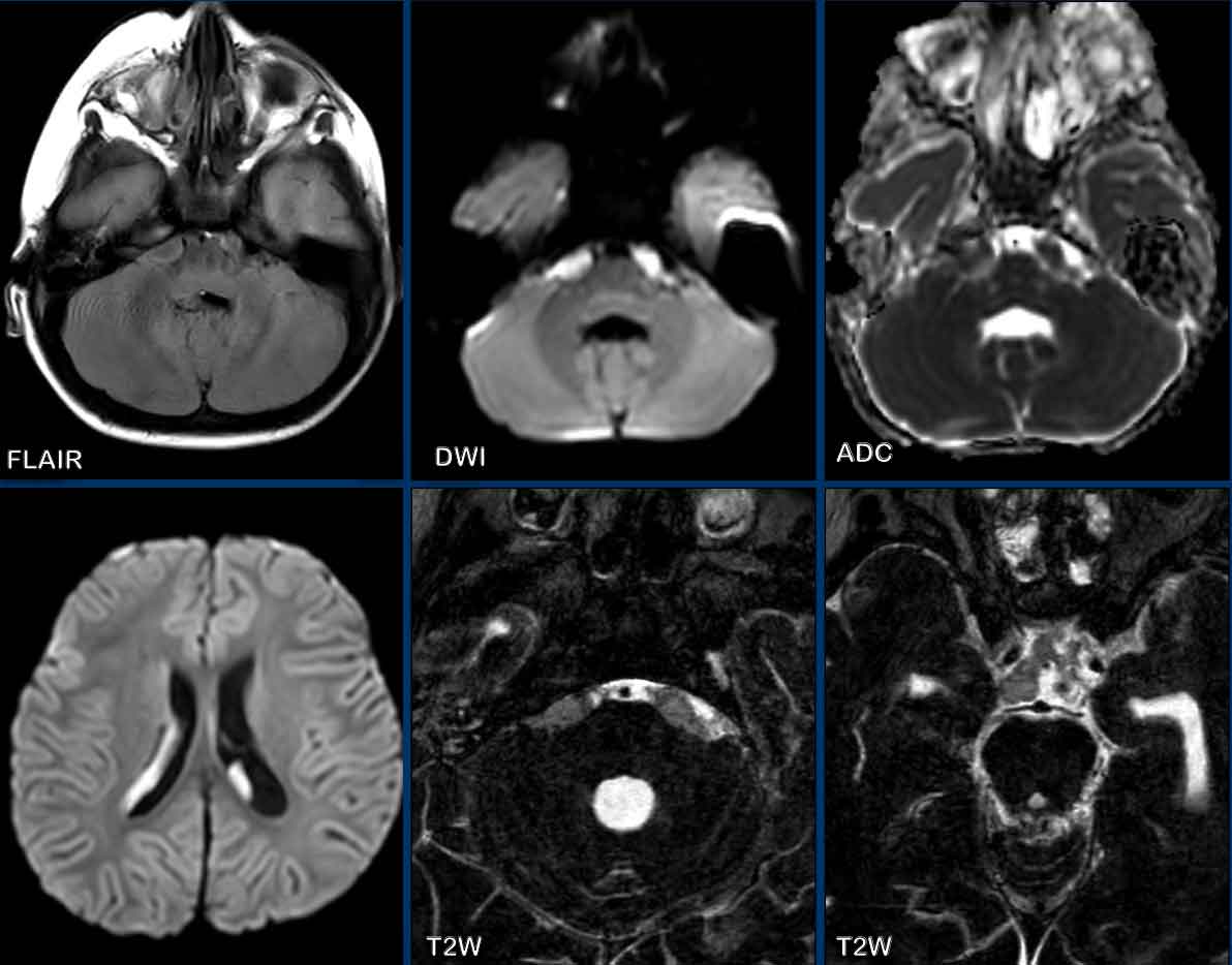 Figure 1 from Cerebral ring enhancing lesion with diffusion restriction in  a South American patient. | Semantic Scholar