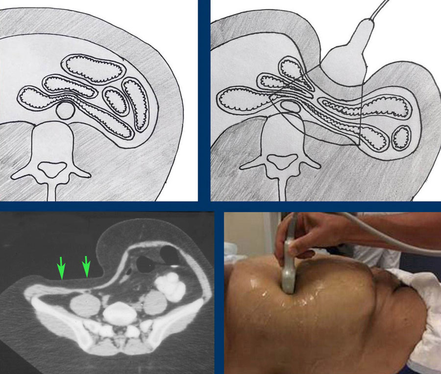 The Radiology Assistant : US of the GI tract - Technique
