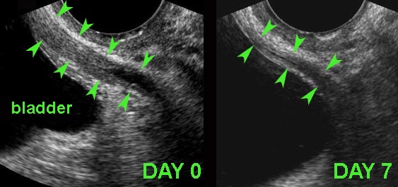 Secondary thickening of the distal ureteric wall after stone passage.