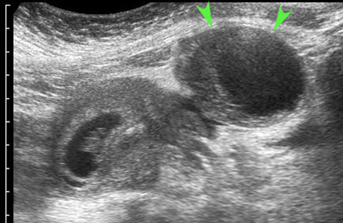 Torsion of luteal cyst in early pregnancy