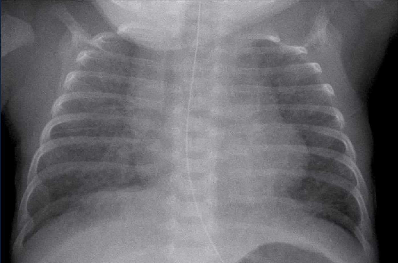 The Radiology Assistant : Neonatal Chest X-Ray