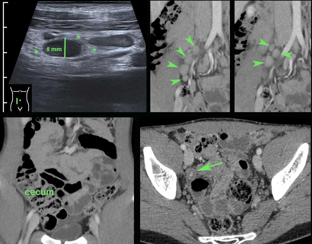 Acute appendicitis with enlarged mesenteric lymph nodes